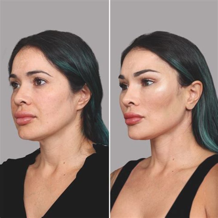 Celebrity Buccal Fat Removal Before and After: Unveiling the Transformation